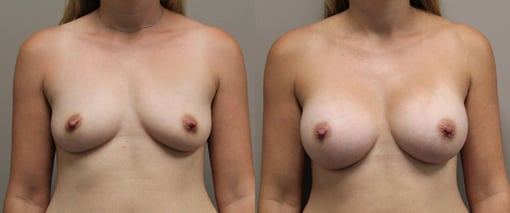 breast augmentation before and after photos by kryger institute of plastic surgery in thousand oaks ca