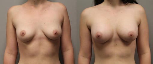 breast augmentation before and after photos by kryger institute of plastic surgery in thousand oaks ca