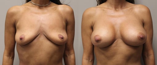 breast augmentation before and after photos by kryger institute of plastic surgery in thousand oaks ca