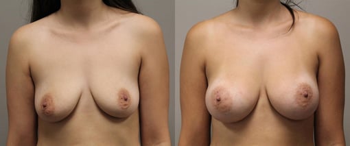 breast augmentation before and after photos by kryger institute of plastic surgery in thousand oaks ca