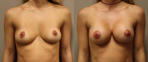 breast augmentation before and after photos by kryger institute of plastic surgery in thousand oaks ca