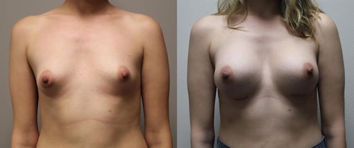 breast augmentation before and after photos by kryger institute of plastic surgery in thousand oaks ca
