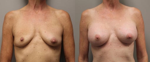 breast augmentation before and after photos by kryger institute of plastic surgery in thousand oaks ca