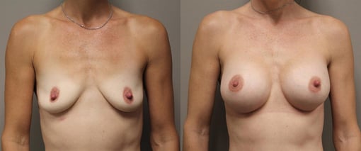breast augmentation before and after photos by kryger institute of plastic surgery in thousand oaks ca