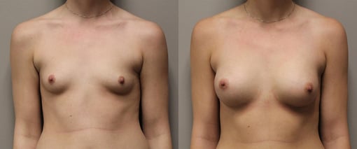breast augmentation before and after photos by kryger institute of plastic surgery in thousand oaks ca