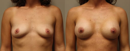 breast augmentation before and after photos by kryger institute of plastic surgery in thousand oaks ca