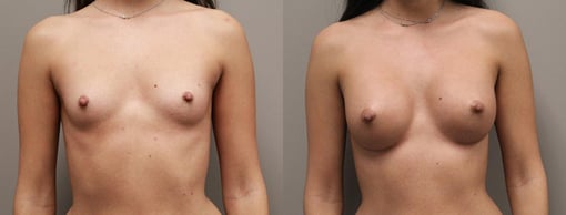 breast augmentation before and after photos by kryger institute of plastic surgery in thousand oaks ca