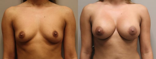 breast augmentation before and after photos by kryger institute of plastic surgery in thousand oaks ca