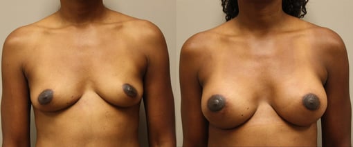 breast augmentation before and after photos by kryger institute of plastic surgery in thousand oaks ca