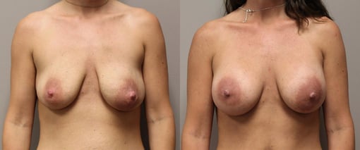 breast augmentation before and after photos by kryger institute of plastic surgery in thousand oaks ca