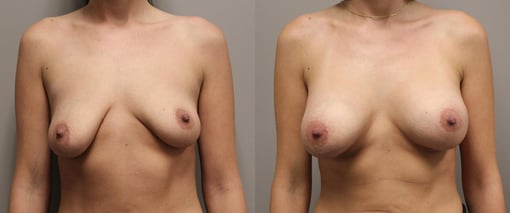 breast augmentation before and after photos by kryger institute of plastic surgery in thousand oaks ca