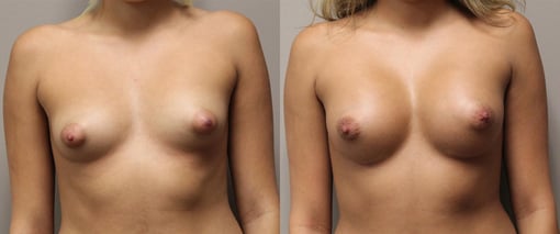 breast augmentation before and after photos by kryger institute of plastic surgery in thousand oaks ca