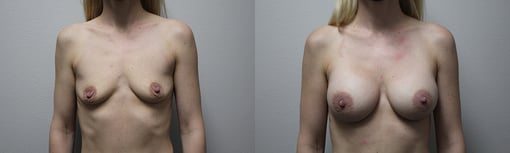 breast augmentation before and after photos by kryger institute of plastic surgery in thousand oaks ca