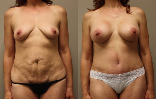 breast augmentation before and after photos by kryger institute of plastic surgery in thousand oaks ca