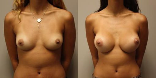 breast augmentation before and after photos by kryger institute of plastic surgery in thousand oaks ca