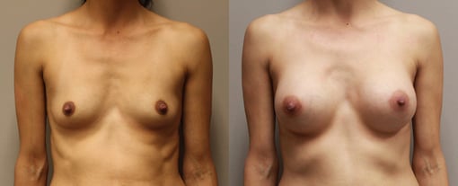 breast augmentation before and after photos by kryger institute of plastic surgery in thousand oaks ca