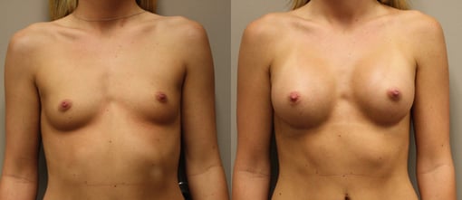 breast augmentation before and after photos by kryger institute of plastic surgery in thousand oaks ca