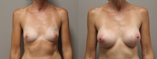 breast augmentation before and after photos by kryger institute of plastic surgery in thousand oaks ca