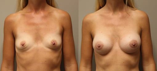 breast augmentation before and after photos by kryger institute of plastic surgery in thousand oaks ca