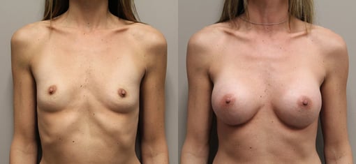 breast augmentation before and after photos by kryger institute of plastic surgery in thousand oaks ca