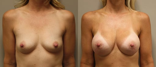 breast augmentation before and after photos by kryger institute of plastic surgery in thousand oaks ca