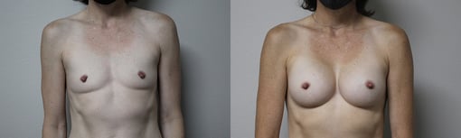 breast augmentation before and after photos by kryger institute of plastic surgery in thousand oaks ca