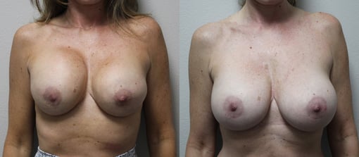 breast implant replacement before and after photos by kryger institute of plastic surgery in thousand oaks ca