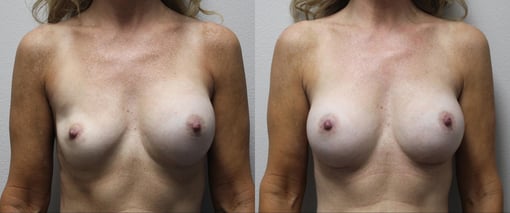 breast implant replacement before and after photos by kryger institute of plastic surgery in thousand oaks ca