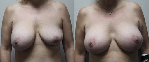 breast implant replacement before and after photos by kryger institute of plastic surgery in thousand oaks ca