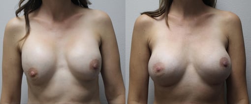 breast implant replacement before and after photos by kryger institute of plastic surgery in thousand oaks ca