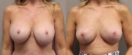 breast implant replacement before and after photos by kryger institute of plastic surgery in thousand oaks ca