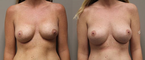 breast implant replacement before and after photos by kryger institute of plastic surgery in thousand oaks ca