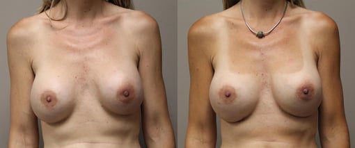 breast implant replacement before and after photos by kryger institute of plastic surgery in thousand oaks ca