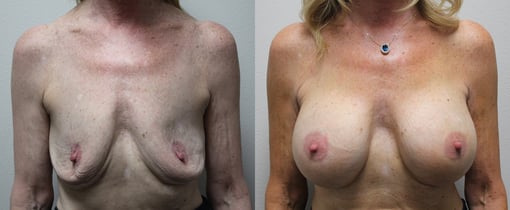 breast implant replacement before and after photos by kryger institute of plastic surgery in thousand oaks ca