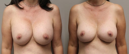 breast implant replacement before and after photos by kryger institute of plastic surgery in thousand oaks ca