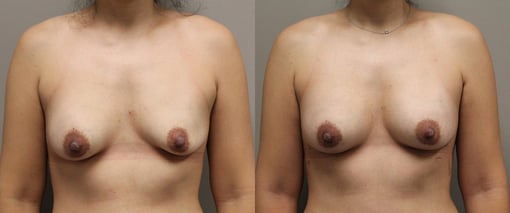 breast implant replacement before and after photos by kryger institute of plastic surgery in thousand oaks ca