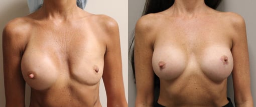 breast implant replacement before and after photos by kryger institute of plastic surgery in thousand oaks ca