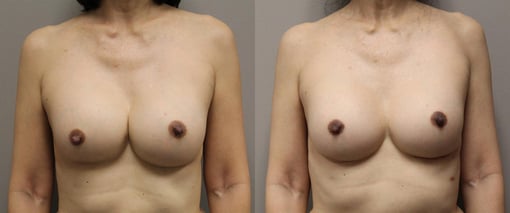 breast implant replacement before and after photos by kryger institute of plastic surgery in thousand oaks ca