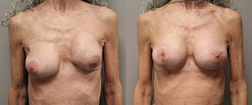 breast implant replacement before and after photos by kryger institute of plastic surgery in thousand oaks ca