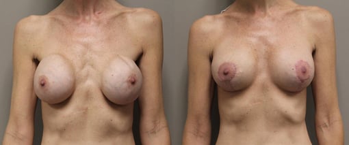 breast implant replacement before and after photos by kryger institute of plastic surgery in thousand oaks ca