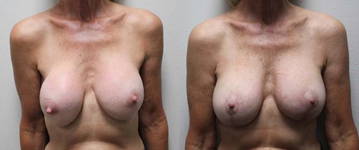 breast implant replacement before and after photos by kryger institute of plastic surgery in thousand oaks ca