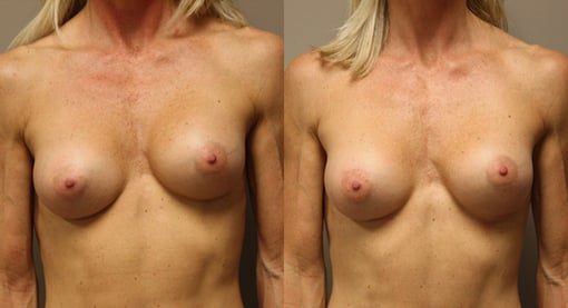 breast implant replacement before and after photos by kryger institute of plastic surgery in thousand oaks ca