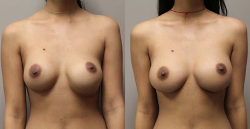 breast implant replacement before and after photos by kryger institute of plastic surgery in thousand oaks ca