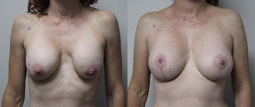 breast implant replacement before and after photos by kryger institute of plastic surgery in thousand oaks ca