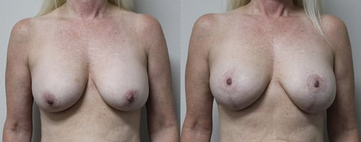 breast implant replacement before and after photos by kryger institute of plastic surgery in thousand oaks ca