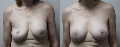 breast implant replacement before and after photos by kryger institute of plastic surgery in thousand oaks ca