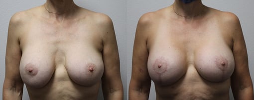 breast implant replacement before and after photos by kryger institute of plastic surgery in thousand oaks ca