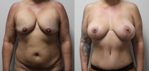 breast implant replacement before and after photos by kryger institute of plastic surgery in thousand oaks ca