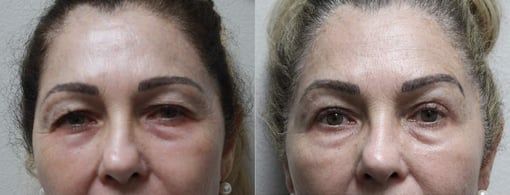 blepharoplasty before and after photos by kryger institute of plastic surgery in thousand oaks ca