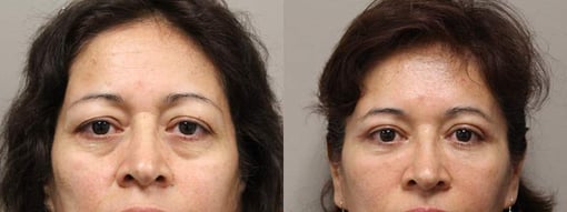 blepharoplasty before and after photos by kryger institute of plastic surgery in thousand oaks ca